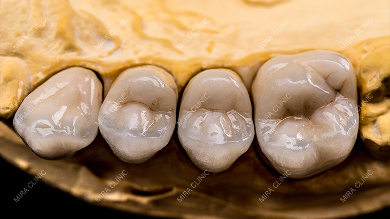 What Is a Dental Filling?